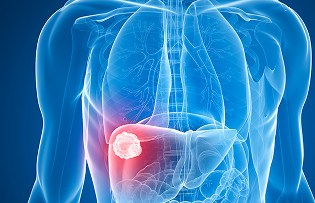 خبراء: ارتفاع معدلات الإصابة بسرطان الكبد بين المصريين.. والاكتشافات الحديثة حققت تقدمًا في العلاج